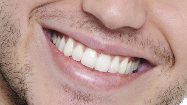 حکم نجاست دندان مصنوعی و ترمیم‌شده